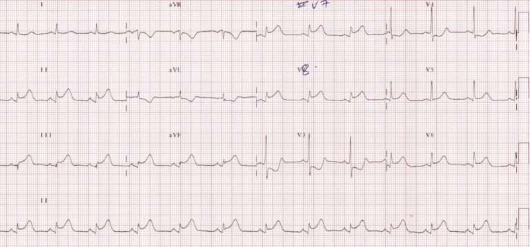 Posterior Myocardial Infarction • LITFL • ECG Library Diagnosis