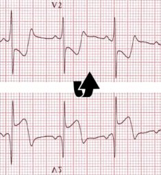 Posterior Myocardial Infarction • LITFL • ECG Library Diagnosis