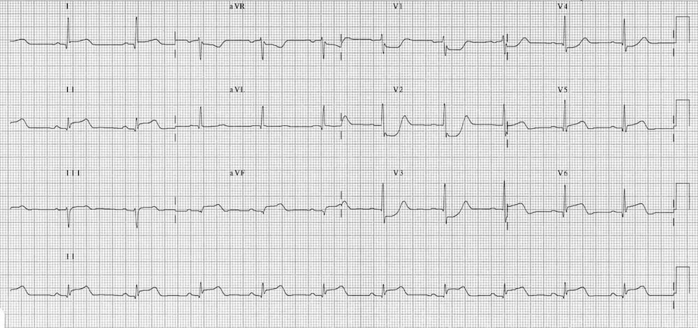 Type 2 ECG with saddle-back type ST-segment elevation in V 2 