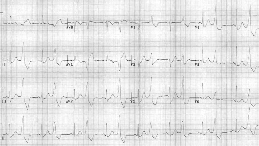 ECG Premature Ventricular Complex (PVC) Bigeminy