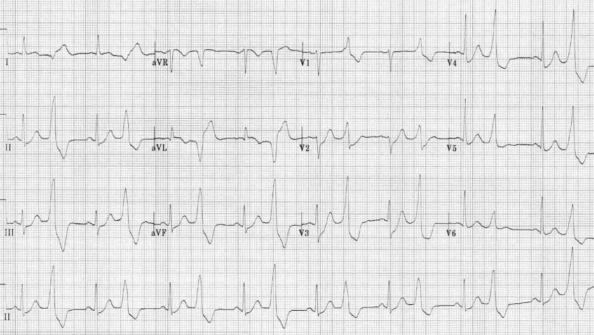 premature ventricular contraction ecg