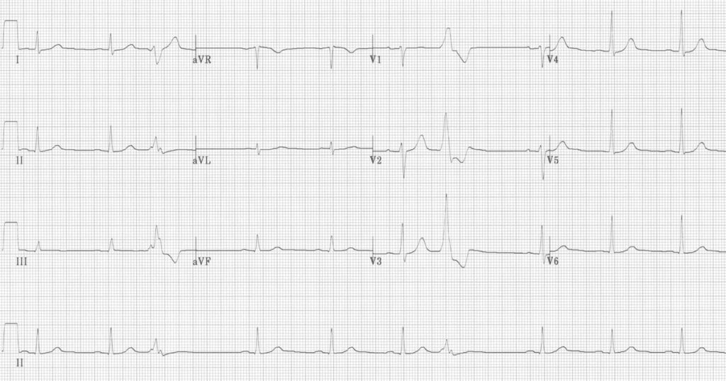 ECG Premature Ventricular Complex (PVC) Quadrigeminy