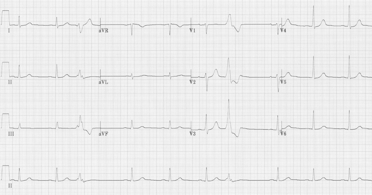 Premature Ventricular Complex Quadrigeminy