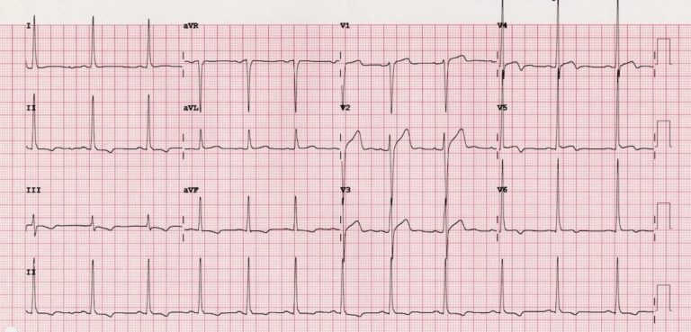 Wellens Syndrome • LITFL • ECG Library Eponym