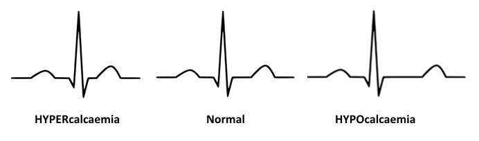 Hypercalcaemia ECG changes • LITFL • ECG Library