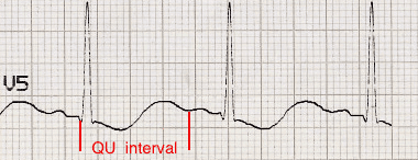 Hypokalemia Ecg Strip