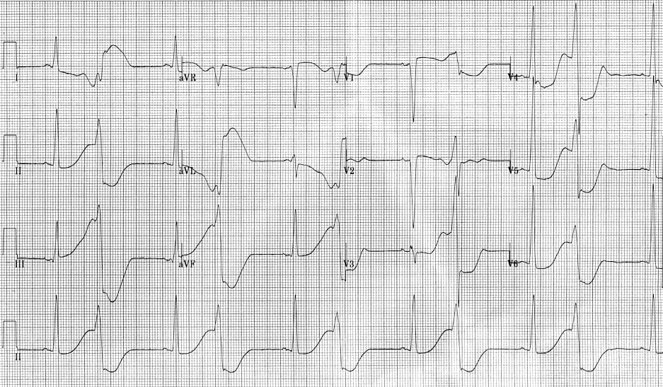 Polymorphic Vt And Torsades De Pointes Tdp Litfl