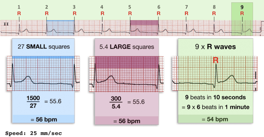 ECG Rate Interpretation LITFL Medical Blog ECG Library Basics