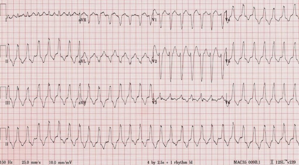 ECG RVOT VT LBBB Inferior axis 2