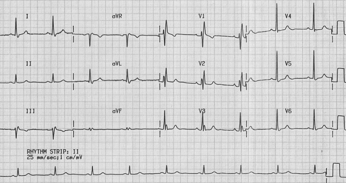 Right Bundle Branch Block ECG Pattern