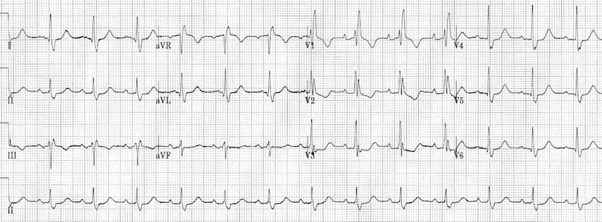 Right Bundle Branch Block Litfl