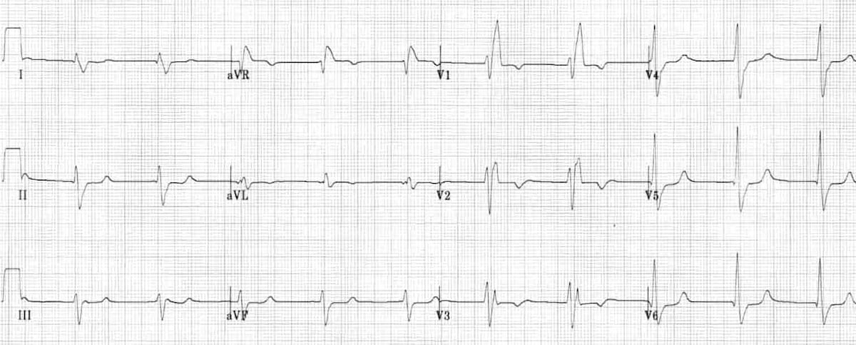 Right Bundle Branch Block Symptoms