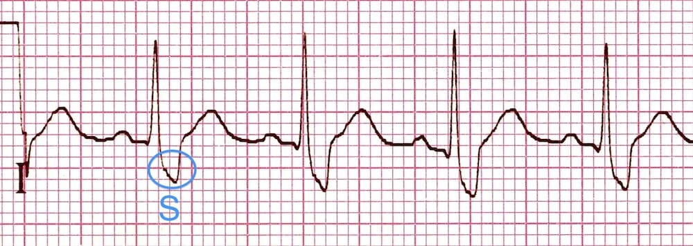 Right Bundle Branch Block Rbbb Litfl Ecg Library Diagnosis