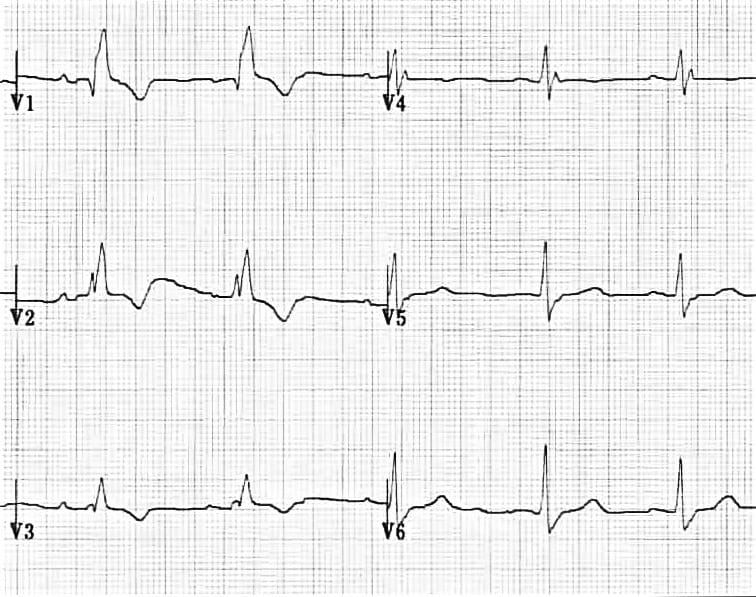 Right Bundle Branch Block (RBBB) • LITFL • ECG Library Diagnosis