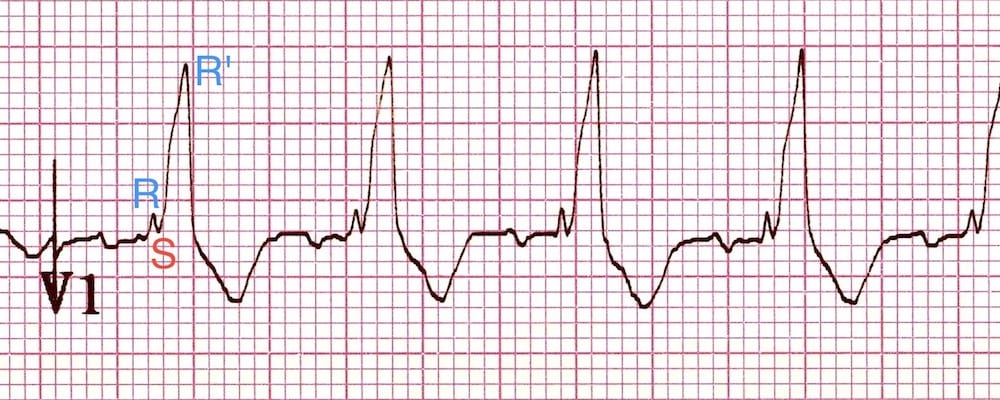 Right Bundle Branch Block Rbbb Litfl Ecg Library Diagnosis 59160 | The ...