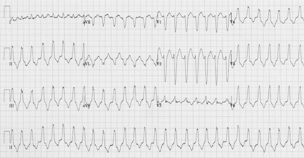 Arrhythmogenic Right Ventricular Dysplasia (ARVD) • ECG Library