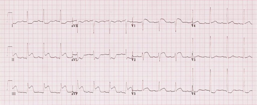 ECG Right ventricular infarction 1