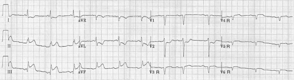 ECG Right ventricular infarction 3 Right sided leads