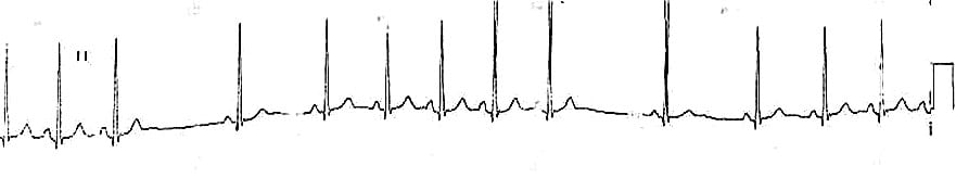 ECG Essentials - Sinus Rhythms & Arrhythmias