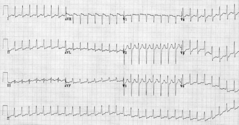 Svt Depression ECG Case 008 • LITFL • ECG Top 100 Self-Assessment Quiz
