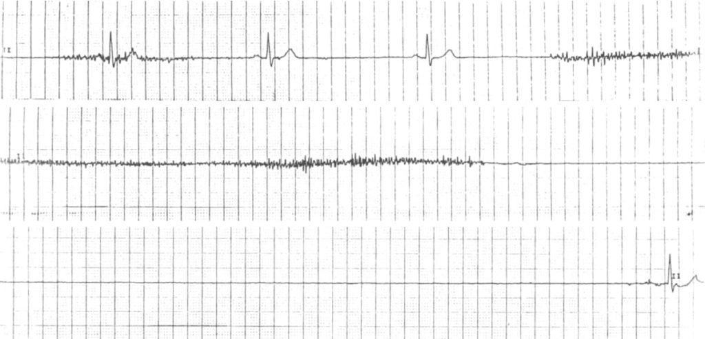 ECG Sinus Arrest 1 strip 3