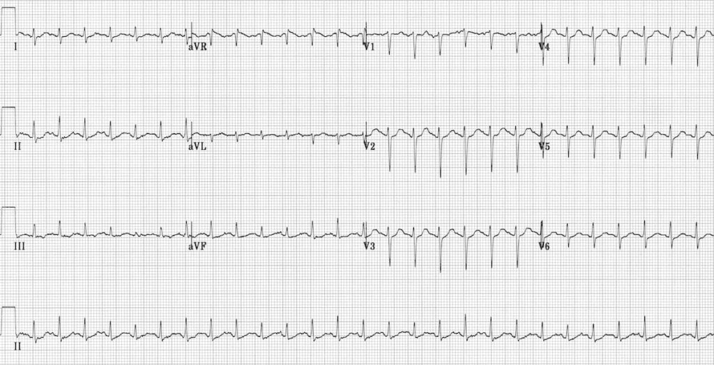 Sinus Tachycardia Litfl Ecg Library Diagnosis