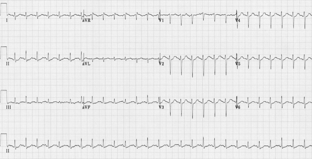 Myocarditis ECG Changes LITFL ECG Library Diagnosis