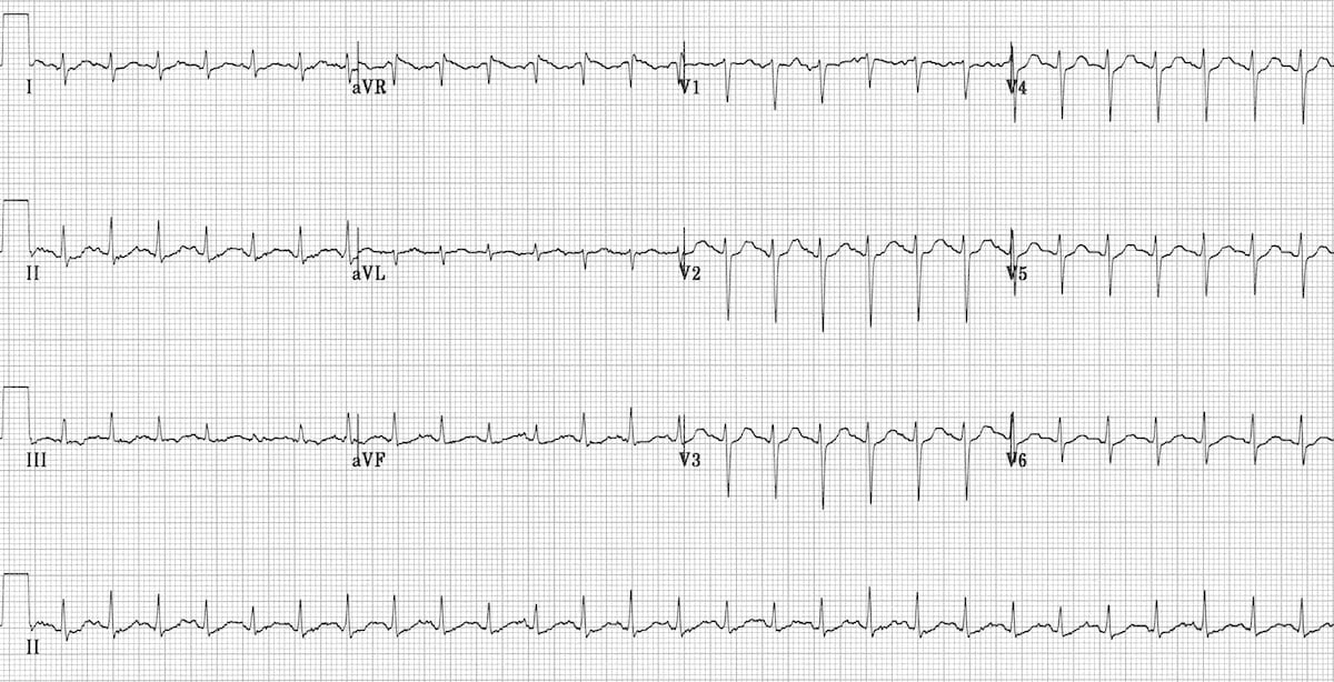 Sinus Tachycardia Litfl Ecg Library Diagnosis