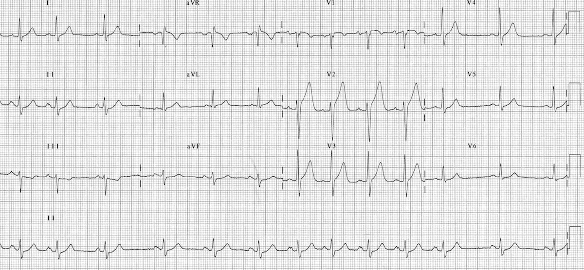 sinus arrhythmia rhythm strip