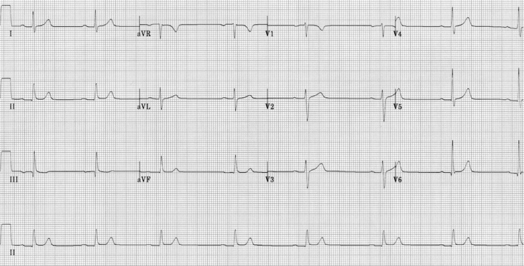 ECG Sinus bradycardia 1st degree AV block