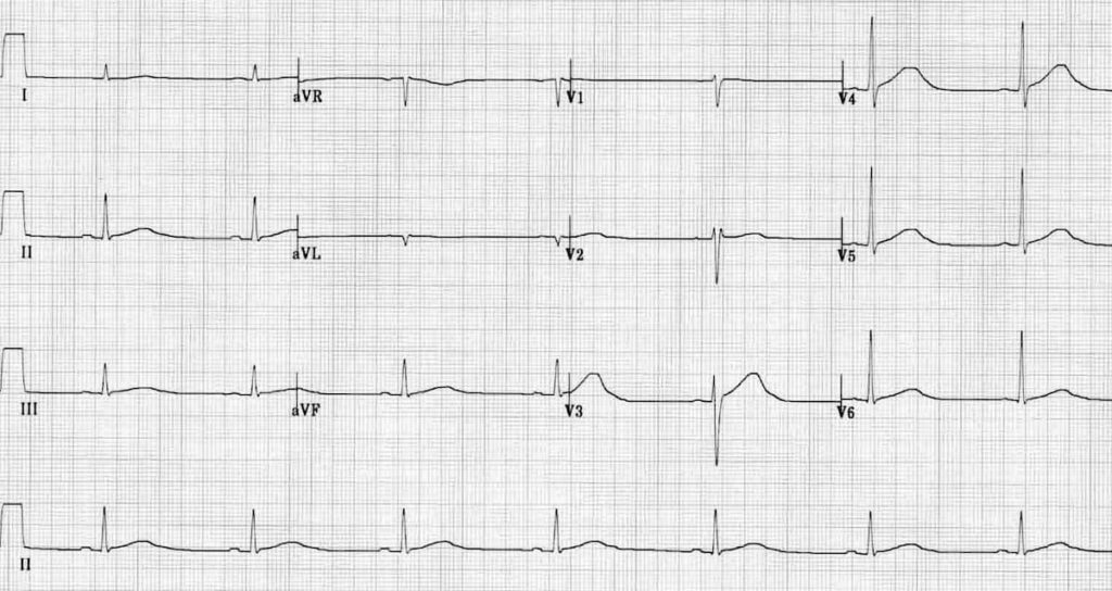 ECG Sinus bradycardia prolonged QT Sotalol OD