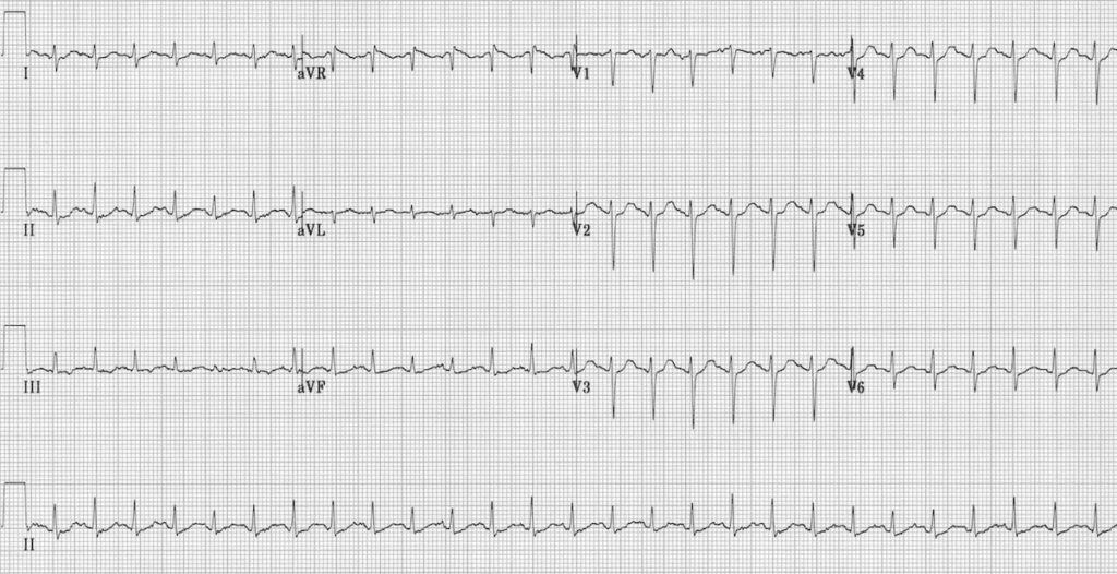 ECG Sinus tachycardia 1