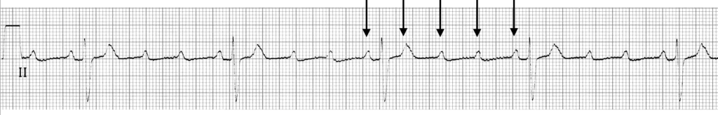 ECG Strip 4 to 1 AV block