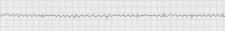 2 1 atrial flutter 2 1 atrial flutter