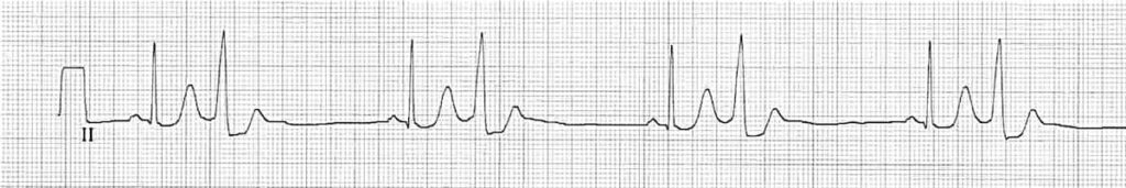 wide qrs complex