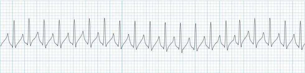 ECG Strip SVT