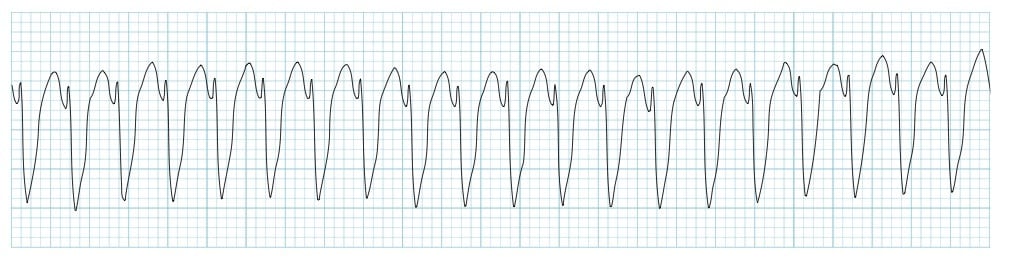 ECG Strip Ventricular tachycardia VT