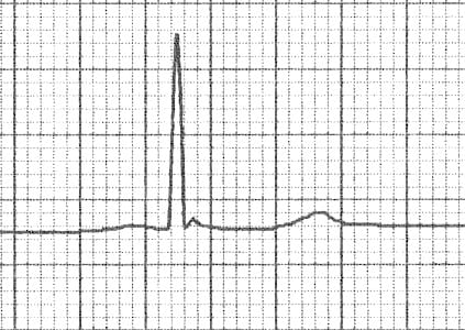 Osborn Wave (J Wave) • LITFL • ECG Library Basics