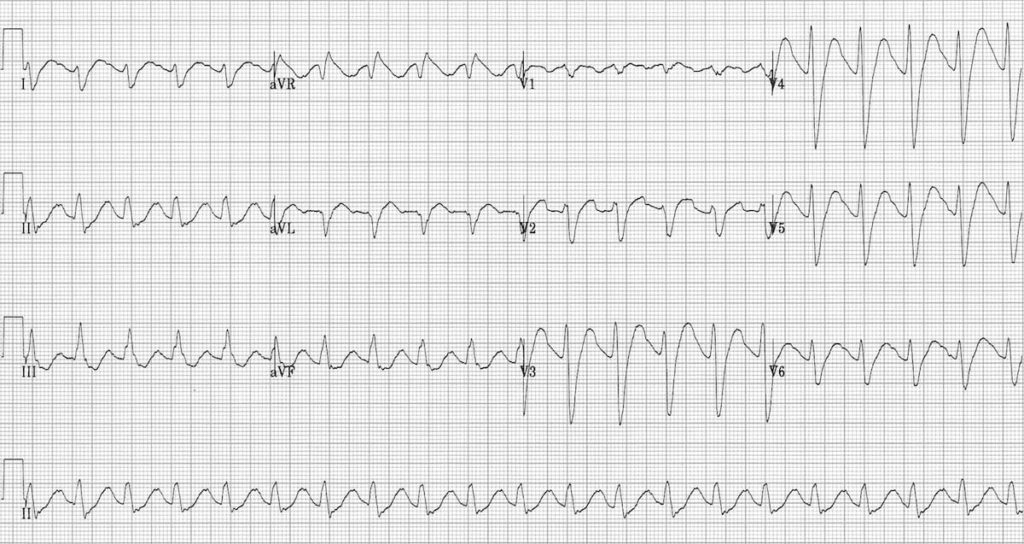 ECG TCA overdose Sodium Channel Blocking Agent Toxicity