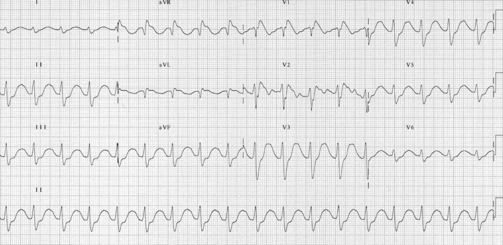 ECG TCA toxicity 1 2