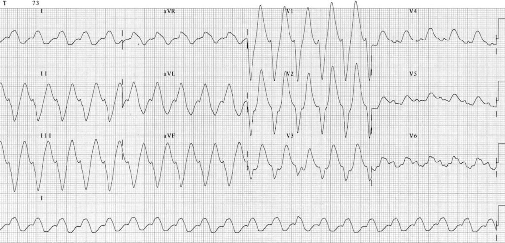 ECG TCA toxicity 2 2