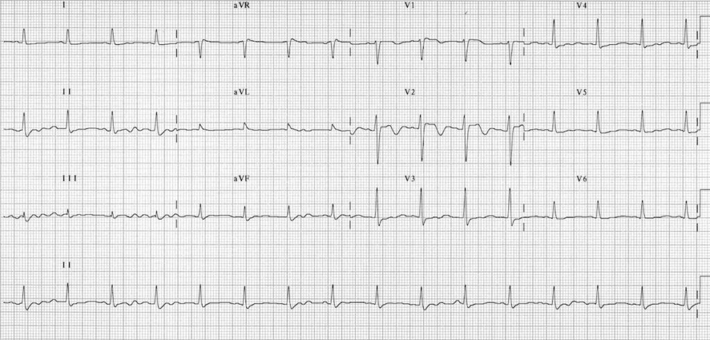 ECG TCA toxicity 3 resolution 2