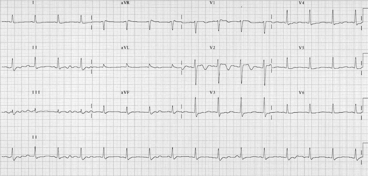 Tricyclic Overdose Litfl Ecg Library