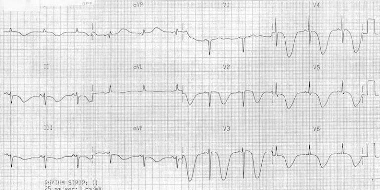 T wave • LITFL • ECG Library Basics