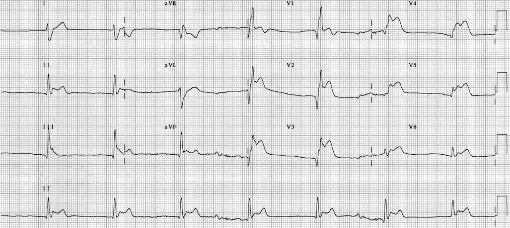 Takotsubo Cardiomyopathy • LITFL • ECG Library Diagnosis