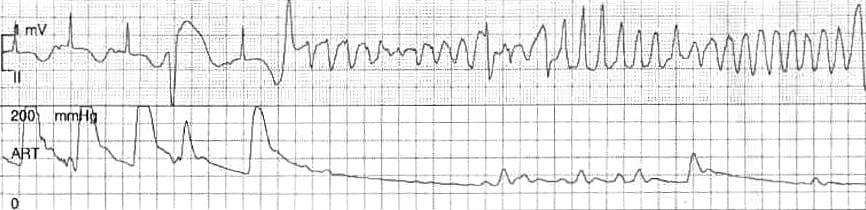 polymorphic ventricular tachycardia ecg