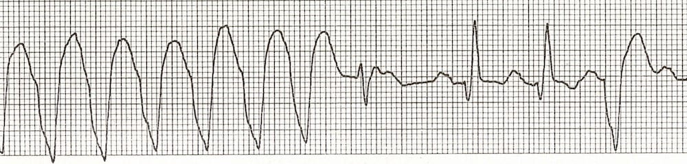 Ventricular Tachycardia – Monomorphic VT • LITFL • ECG Library