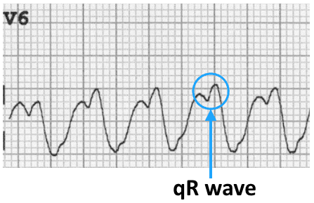 VT versus SVT • LITFL Medical Blog • ECG Library Basics