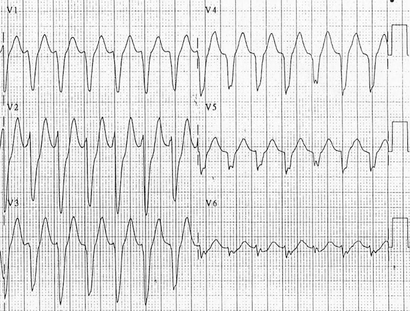 ventricular tachycardia ecg