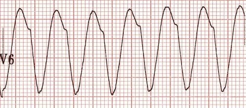 Vt Versus Svt Litfl Medical Blog Ecg Library Basics